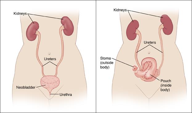 Cystectomy Market