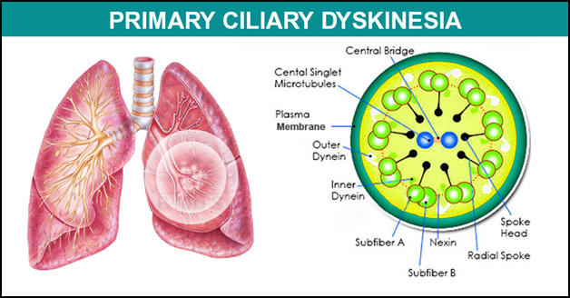 Primary ciliary dyskinesia (PCD) Market