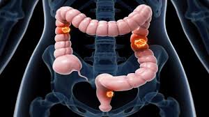 Colorectal Cancer Market