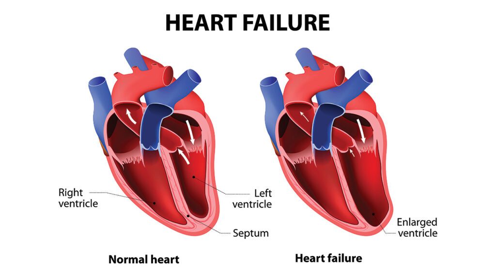 Corlanor approved to reduce hospitalization from worsening heart failure