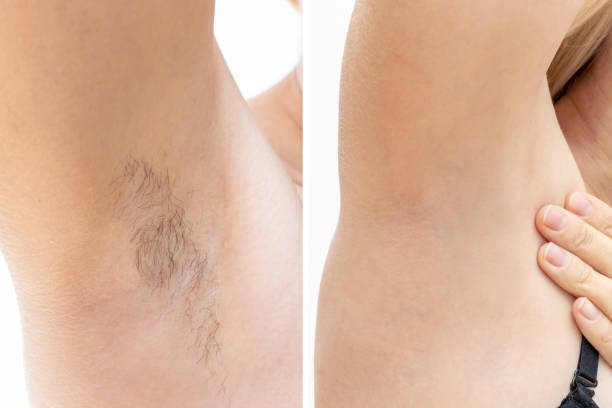 woman's armpit before and after laser hair removal la