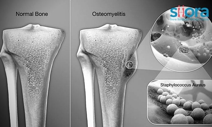 Osteomyelitis