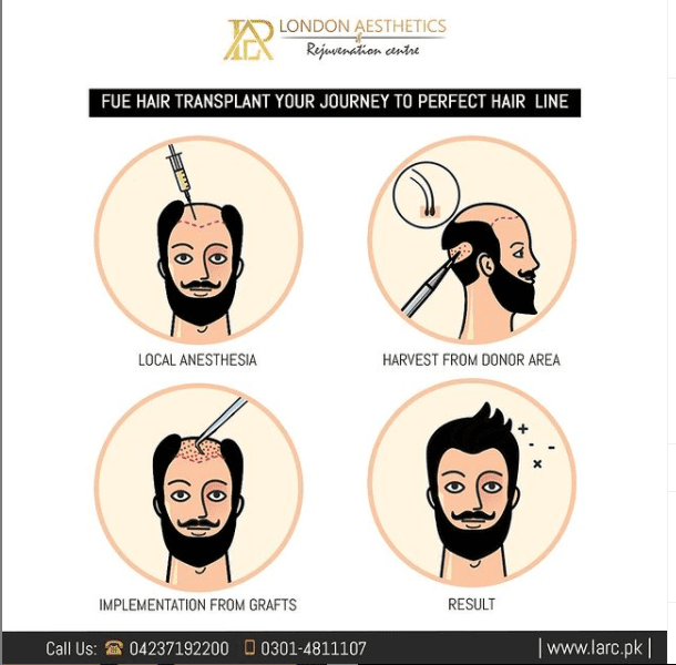 FUE Hair Transplant