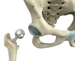 hemiarthroplasty