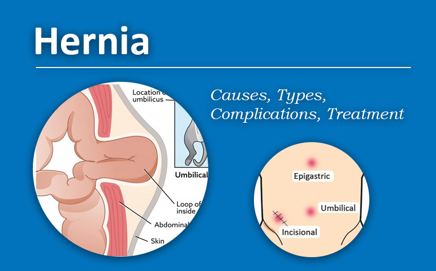 Inguinal Hernia Surgery Cost in Mumbai