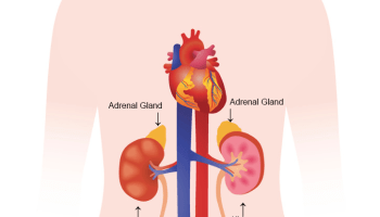 Laparoscopic Cholecystectomy in Mumbai