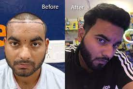 Hair Transplant Clinic