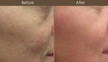 Laser Skin Resurfacing