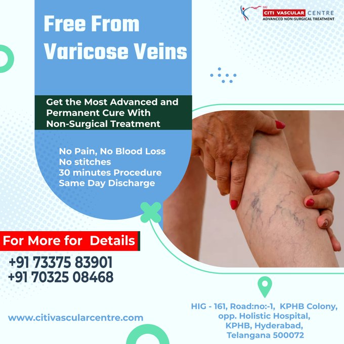 specialist for varicose veins Hyderabad