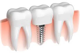 Same Day Dental Implants In Jaipur - DNG Dental Clinic