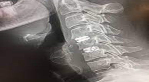 A Guide to Disc Replacement and Cervical Spine Surgery Costs in Kolkata