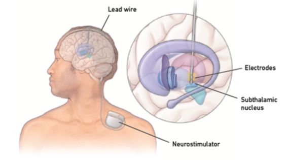 Deep Brain Stimulation (DBS) in Kolkata: A Hope for Advanced Parkinson's Patients