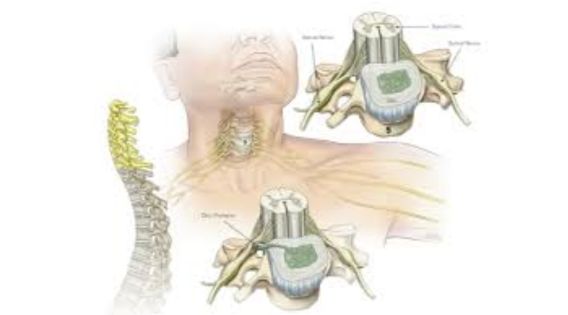 Cervical Spine Neurosurgery in Kolkata Advanced Solutions for Neck Pain