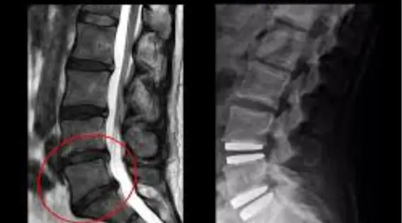 Disc Replacement India Consult the Best Cervical Spine Surgeon in India