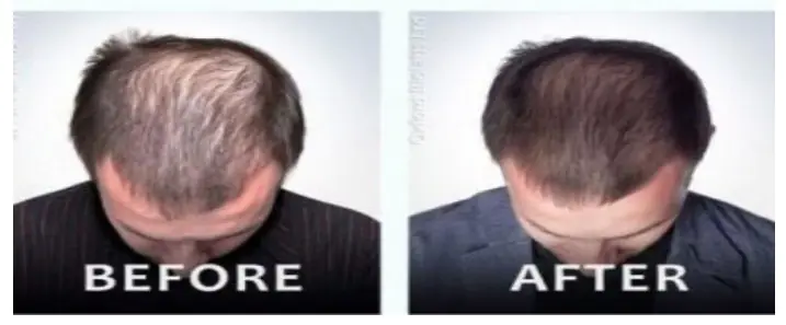 prp hair loss treatment center New Jersey