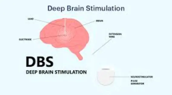 DBS for Parkinsons’ India Deep Brain Stimulation Treatment in Kolkata, India