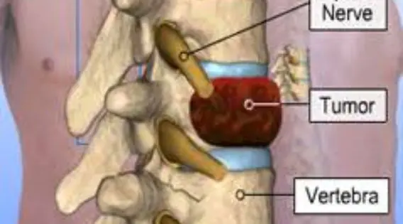 Spine Tumor Surgery in Kolkata: Contact the Best Spine Neurosurgeon in India