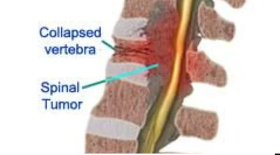 Spinal Tumor Treatment in India: Expert Surgery & Recovery
