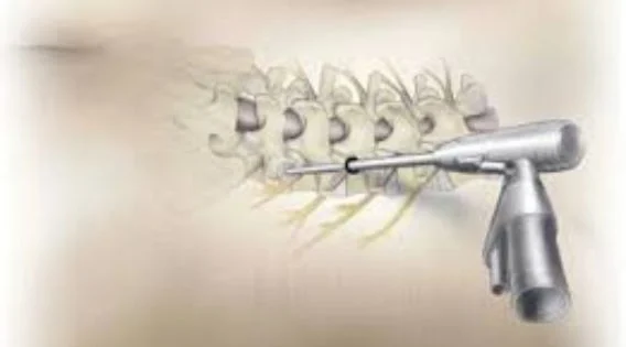 Spine Surgery in India: Quick Recovery in Minimally Invasive Spine Surgery