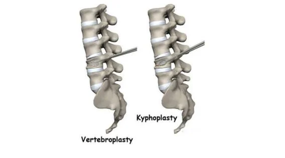 Vertebroplasty and Kyphoplasty Recovery Time in the Elderly: Consult a Top Spine Surgeon in India, Kolkata